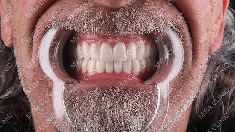  Thommen Dieter returned to Mira Clinic for the final stage